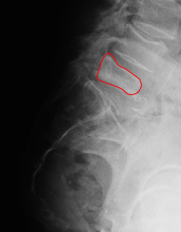Radiographie du rachis lombaire de profil mettant en évidence une fracture tassement vertébral de la vertèbre L5 (vertèbre contourée en rouge)