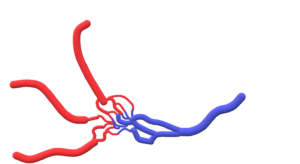 Une malformation artérioveineuse (MAV) est une connection anormale entre les artères (rouge) et les veines (bleu).La prise en charge d’une MAV des tissus mous est hautement pluridisciplinaire,et la radiologie interventionnelle joue un rôle clé, par l’embolisation (la déconnexion) des artères.