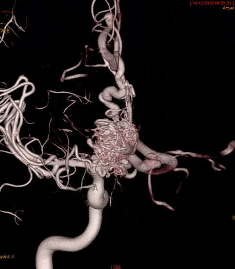 CHRU De Tours Neuro Radiologie Interventionnelle Malformation Art rio 