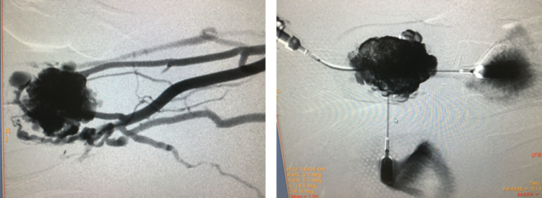 Traitement par radiologie interventionnelle d’une malformation veineuse du bras.À gauche, on visualise le réseau vasculaire veineux anormal.À droite, l’injection de l’agent sclérosant est rendue possible sans risque grâce à la technique du circuit ouvert.