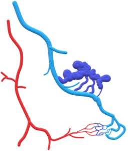 Représentation schématique d’une malformation veineuse,c’est-à-dire une dilatation anormale du réseau veineux (bleu foncé),qui peut être responsable de douleurs, de déformations de la peau, ou d’une modification de la couleur de la peau.