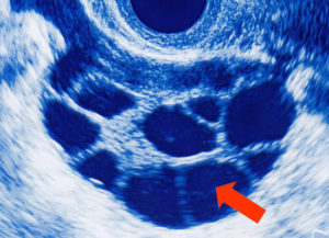 Image échographique de follicules (flèche) en croissance au niveau ovarien