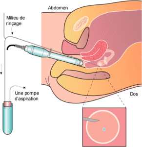 Ponction endovaginale échoguidée avec pompe