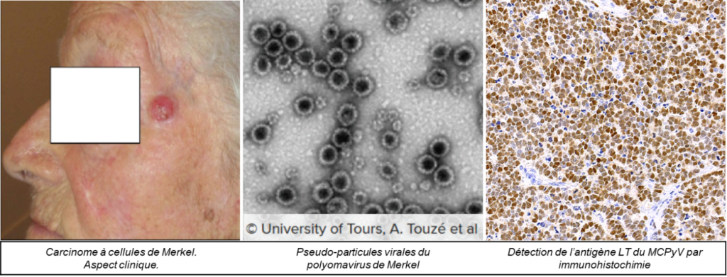 Carcinome à cellules de Merkel / Polyomavirus à cellules de Merkel 