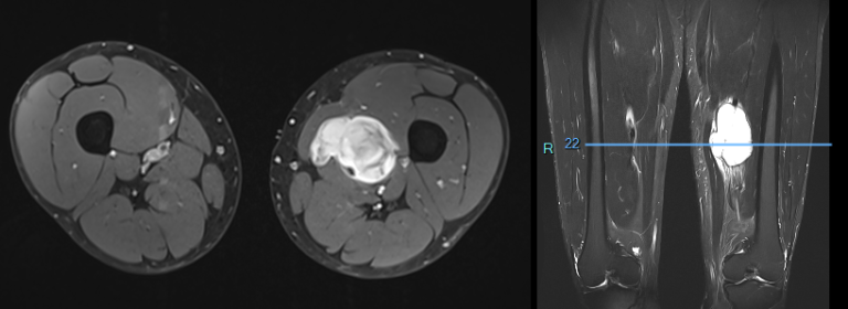 images d’une IRM des deux cuisses d’un patient