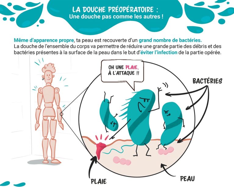 La douche préopératoire : Une douche pas comme les autres ! Introduction